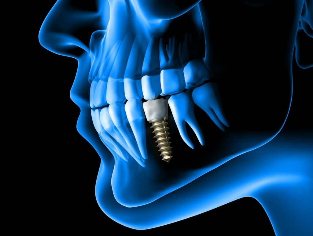 Dental Implant Stuart