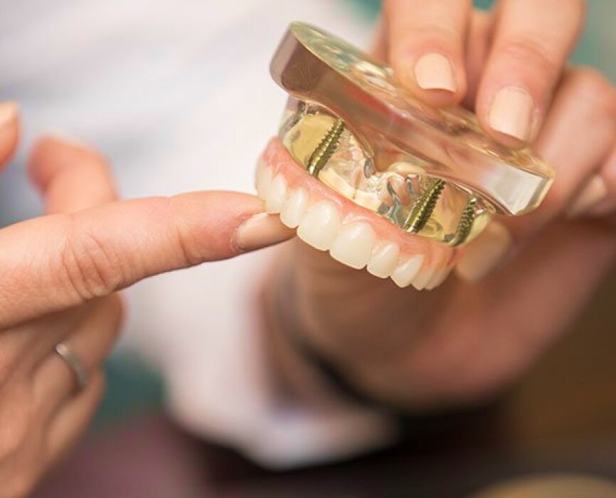 All-on-4 Dental Implants Model