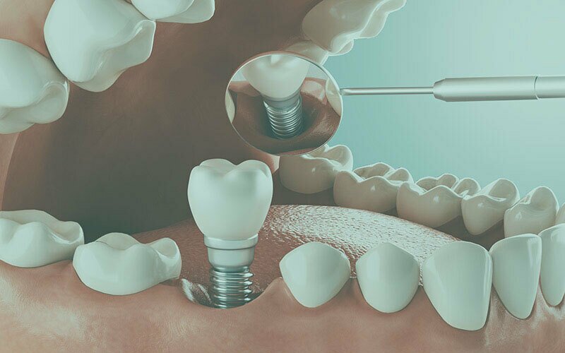 Dental Implants Stuart