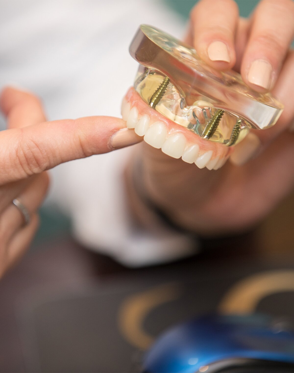 Dr. Sohl showing an all-on-4 dental implant model to patient