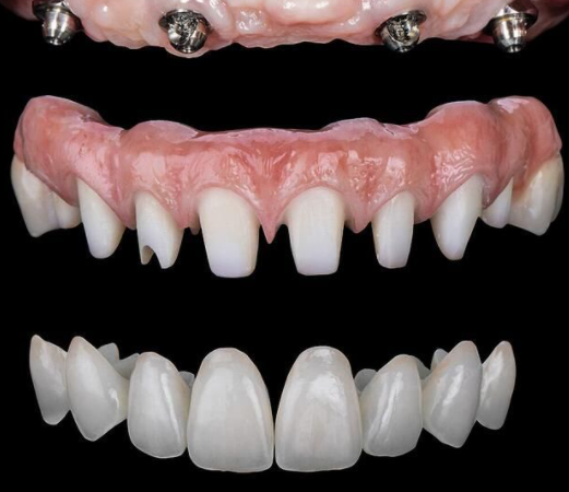 Ultimate Emax implant dentures