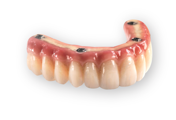 Ultra-Express implant denture