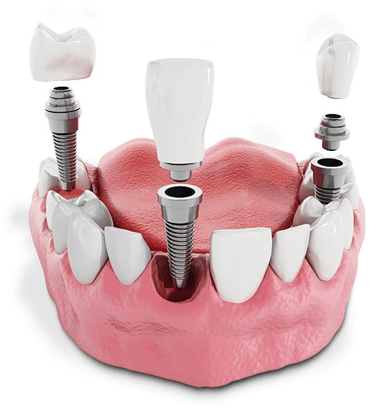 Dental implants example model