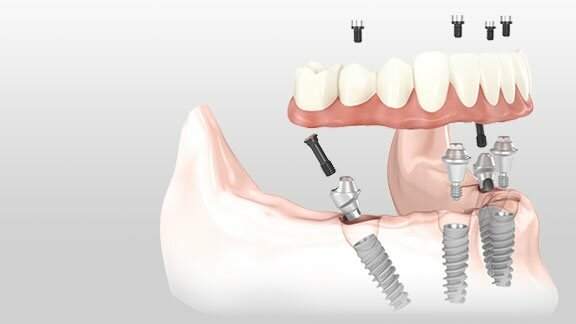 computerized rendering of all on 4 dental implant placement with implant supported dentures