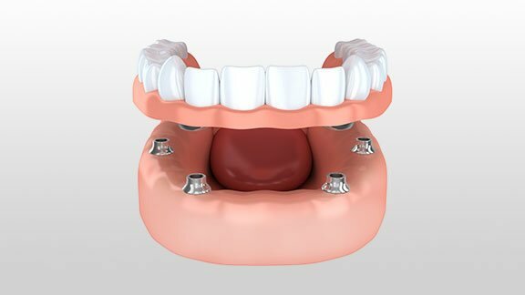 All-on-4 Dental Implants Computer Model