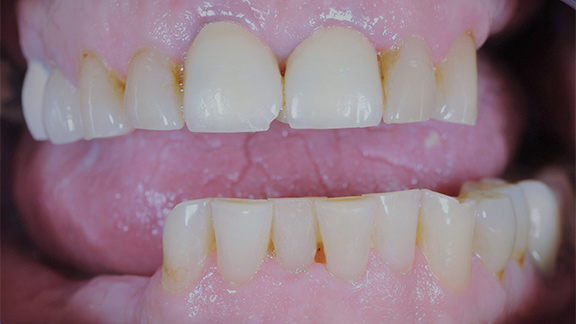 Dental Implants Before