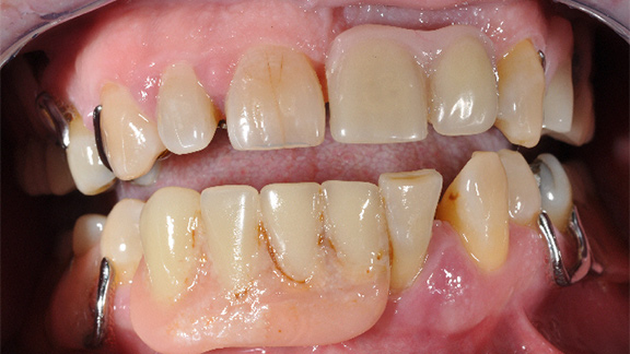 Dental Implants Before