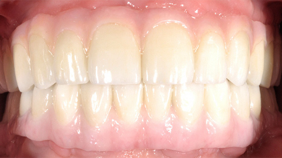 Dental Implants After