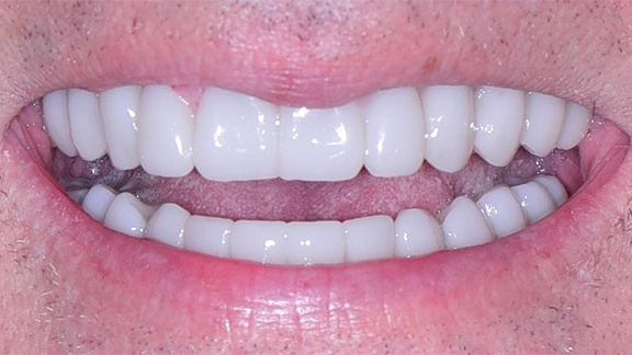 Dental Implants After