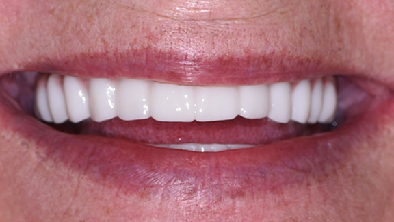 Dental Implants After