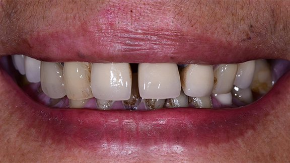 Dental Implants Before