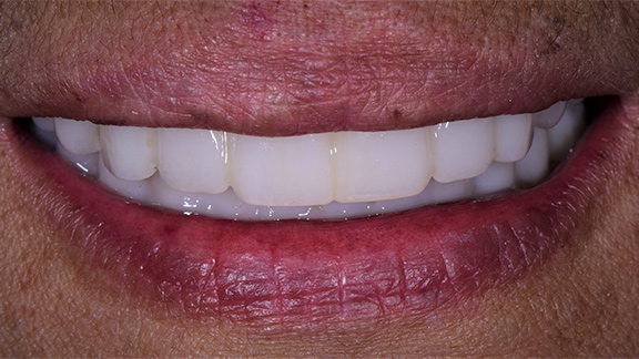 Dental Implants After