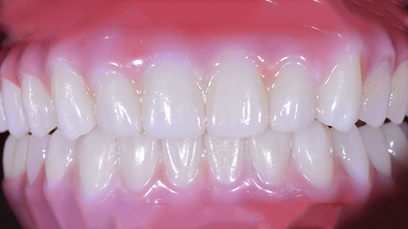 Dental Implants After