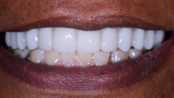 Dental Implants After