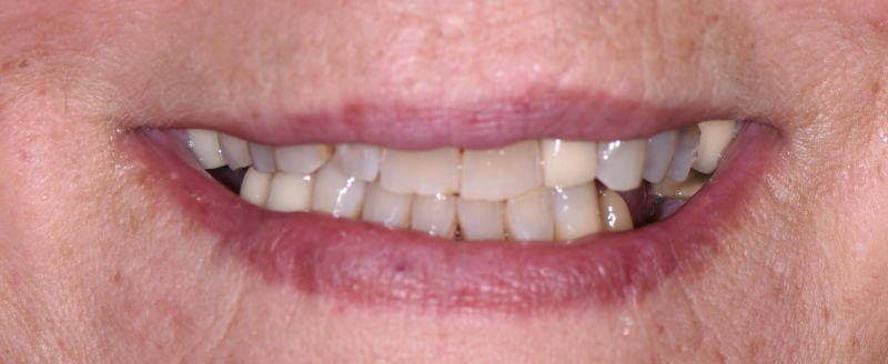 Dental Implants Before