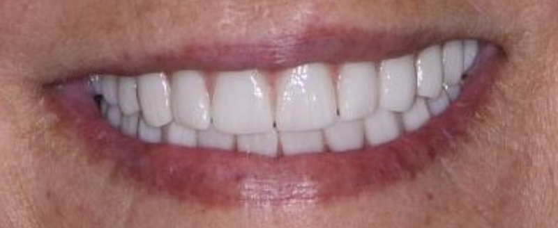 Dental Implants After