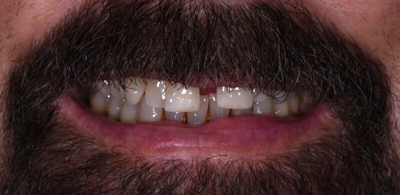 Dental Implants Before