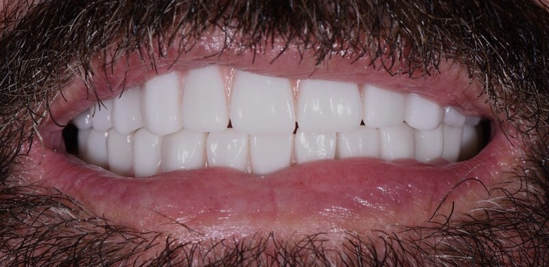 Dental Implants After