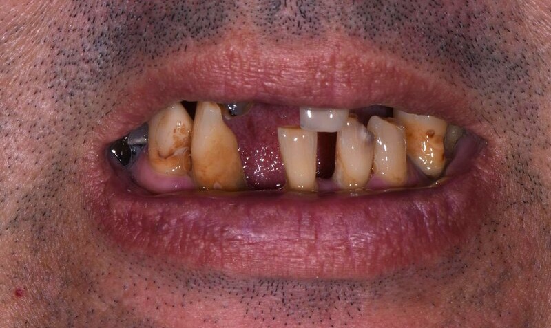 Dental Implants Before