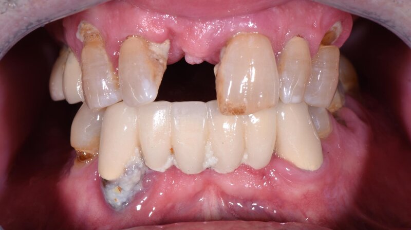 Dental Implants Before
