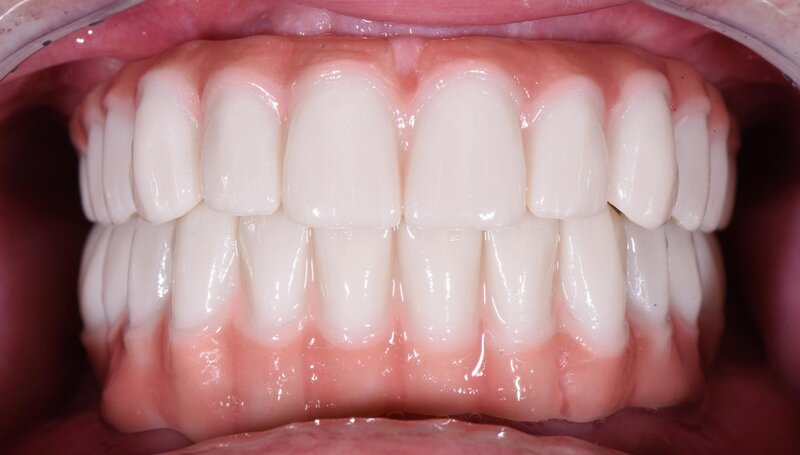 Dental Implants After