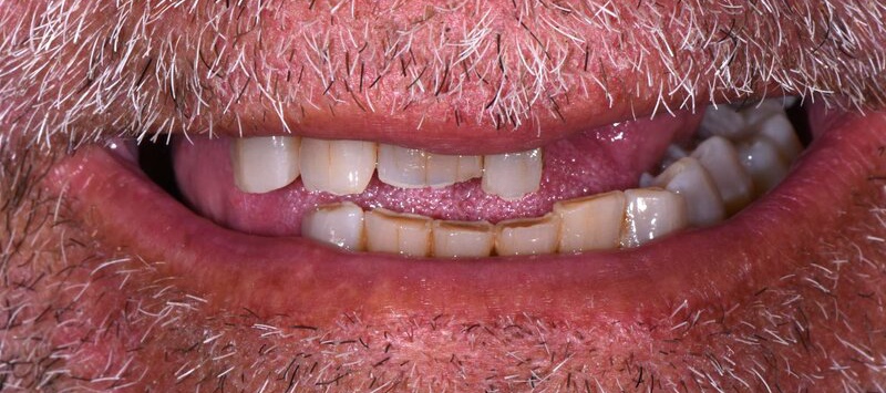 Dental Implants Before