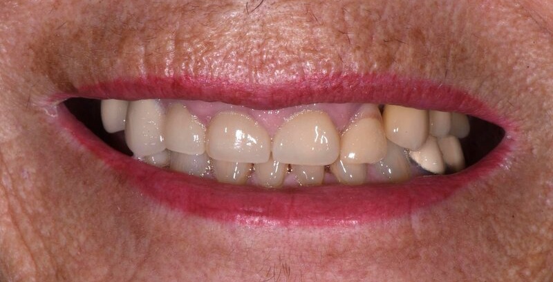 Dental Implants Before