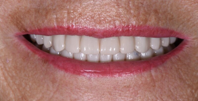 Dental Implants After