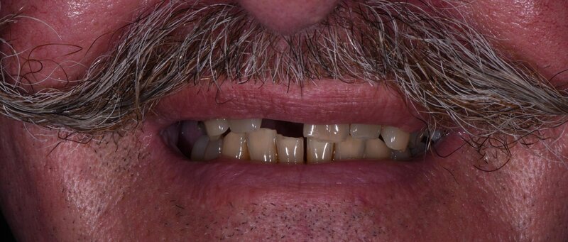 Dental Implants Before