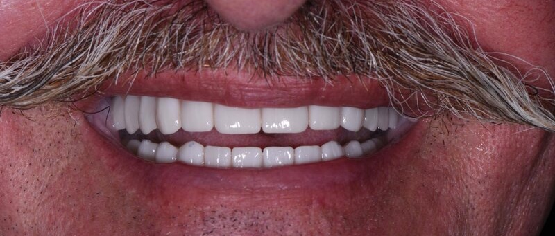 Dental Implants After