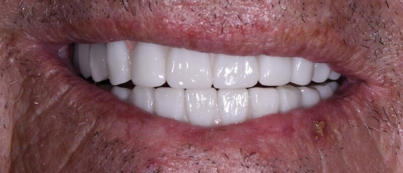 Dental Implants After