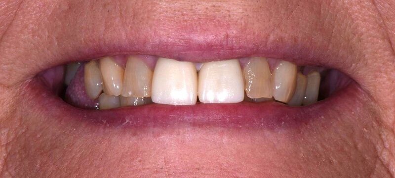 Dental Implants Before