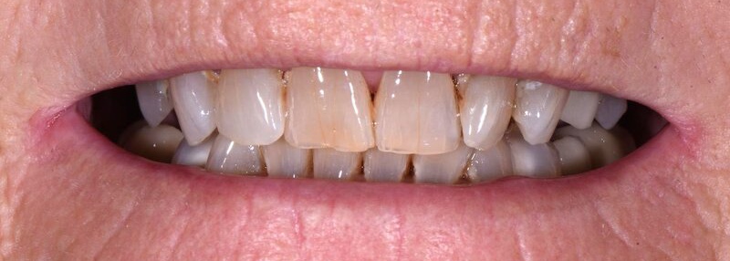 Dental Implants Before