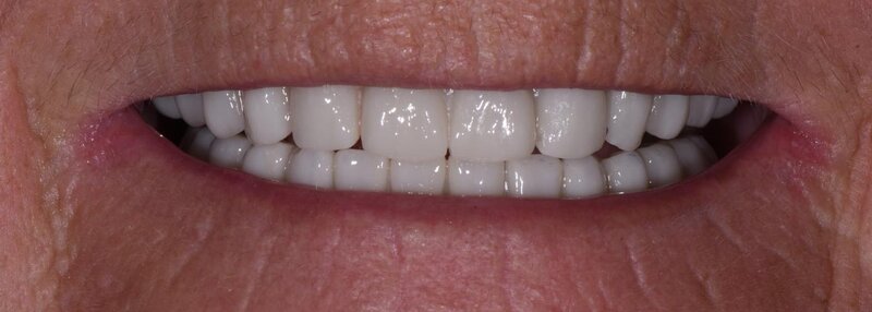 Dental Implants After