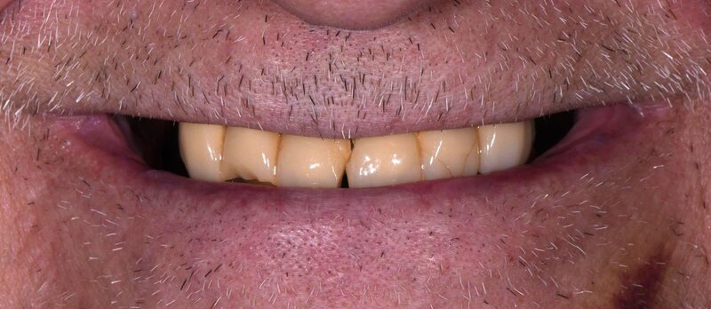Dental Implants Before