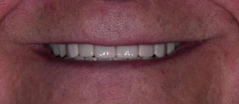 Dental Implants After