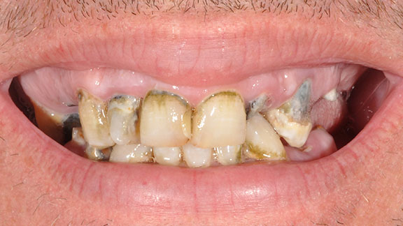 Dental Implants Before