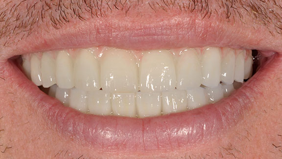 Dental Implants After