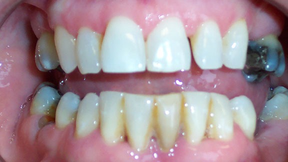 Dental Implants Before