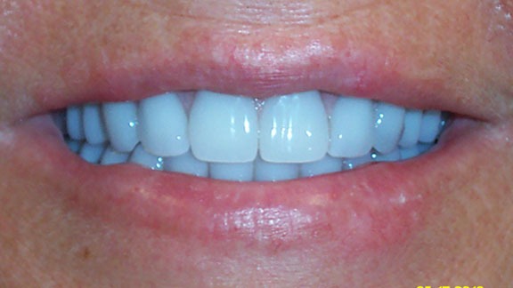 Dental Implants After