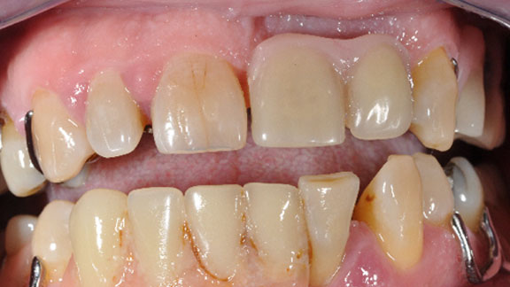 Dental Implants Before