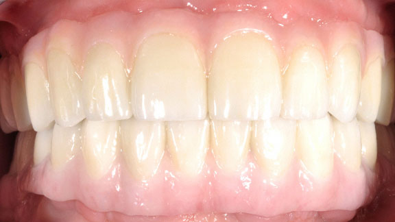Dental Implants After