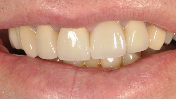 Dental Implants Before