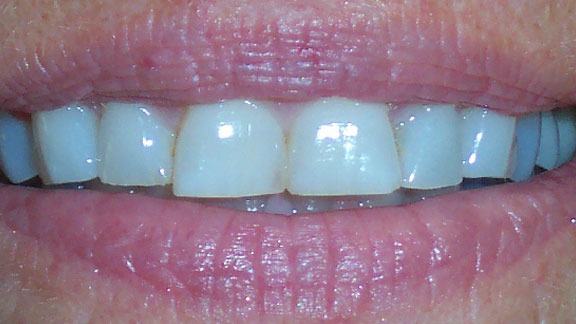 Dental Implants Before