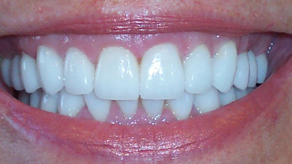 Dental Implants After