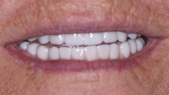 Dental Implants After