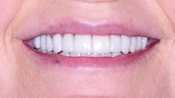 Veneers After