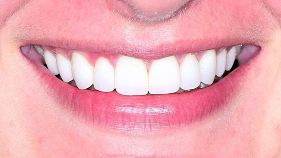 Veneers After