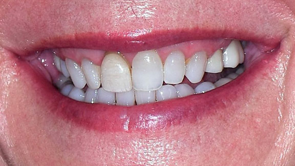 Veneers Before