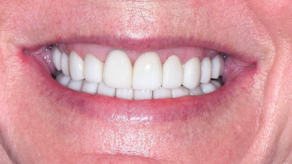 Veneers After